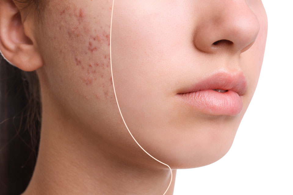 Holistic Skin Care Center | Doctor Masouri - Θεραπεία Ακμής