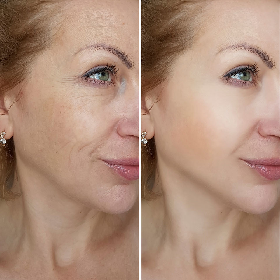 Holistic Skin Care Center | Ιατρός Μασούρη Σοφία - Θεραπεία Fractional Laser
