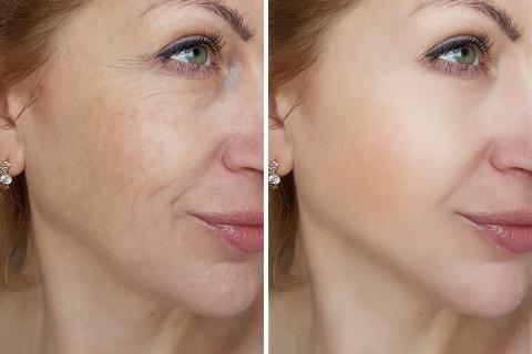 Holistic Skin Care Center | Ιατρός Μασούρη Σοφία - Θεραπεία Fractional Laser